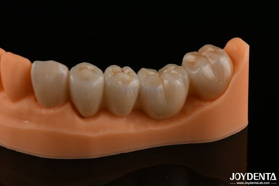 Restaurações dentárias de precisão Zirconia completa Alta resistência flexural Cor natural