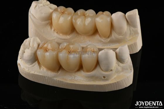 Coroa dental de contorno completo de zircônio resistente ao desgaste