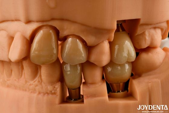 Coroa e ponte de implante personalizáveis obtêm um aspecto natural com resultados duradouros