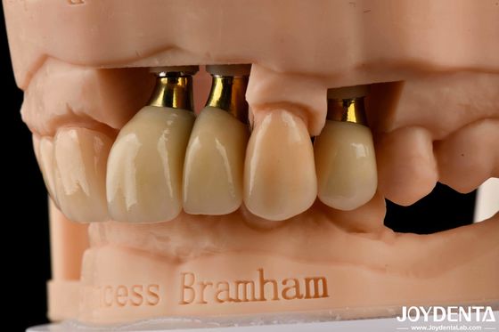 Implantes Dentários de Precisão Coroa e Ponte Solução perfeita para um sorriso esteticamente agradável