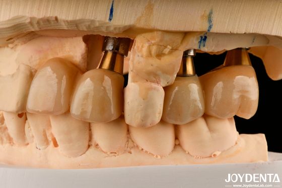 Restauração de Dentes Faltantes Implante Coroa e Ponte Seguro para Oral com Ajuste Precisos