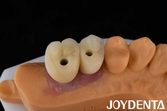 Implante de porcelana coroa e ponte A solução definitiva para a restauração de dentes perdidos