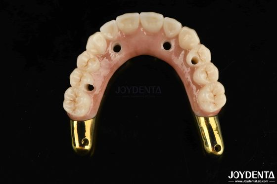 Ponte híbrida de zircônio resistente ao desgaste com dentes e gengivas naturais compatíveis com Ti-Bar