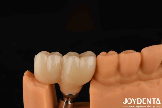 Tipo de fio em forma de V Abutments acabados Compatibilidade com todos os principais sistemas de implantes