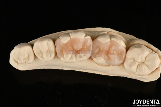 Inlay dentário de porcelana polimerizada natural Onlay para restauração dentária