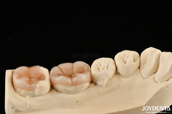Restauração dental com aparência natural