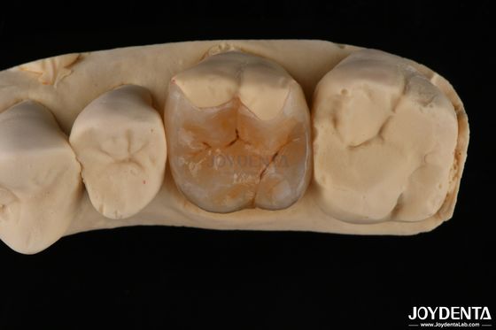 Inlay onlay composto personalizado para restauração dentária minimamente invasiva