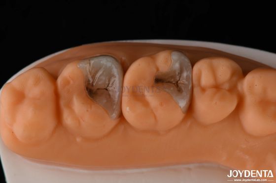 Inlays e onlays compostos para restauração dentária