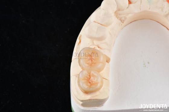 Inlays e Onlays de Zirconia Dental de Aparência Natural