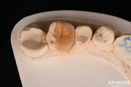 Inlay de zircônio Onlay com cimento adesivo para restauração de dentes danificados