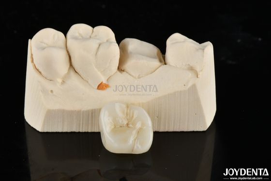Inlays e Onlays de Zirconia Restaurações feitas sob medida para um ajuste e estética incomparáveis
