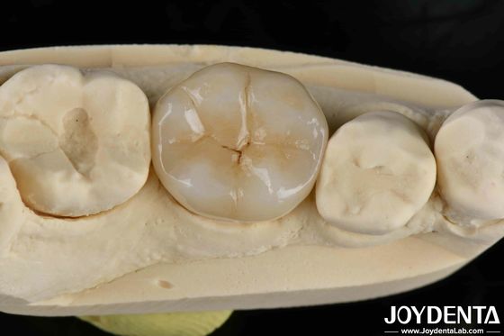 Cimento Adesivo Zirconia Inlays Dentários e Onlays de aparência natural
