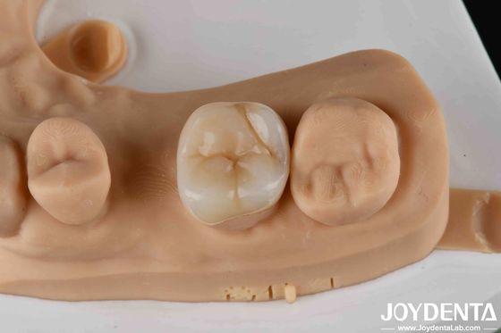 Inlays dentários e onlays de zircônio de alta resistência para restauração dentária