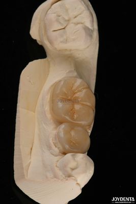Inlays e Onlays Dentários Emax Resistentes a Fracturas 1,5 mm Baixa Translucidez