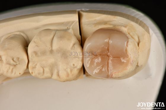 Fácil de limpar Emax Inlays e Onlays Hipoalergênicos Restaurações dentárias biocompativeis
