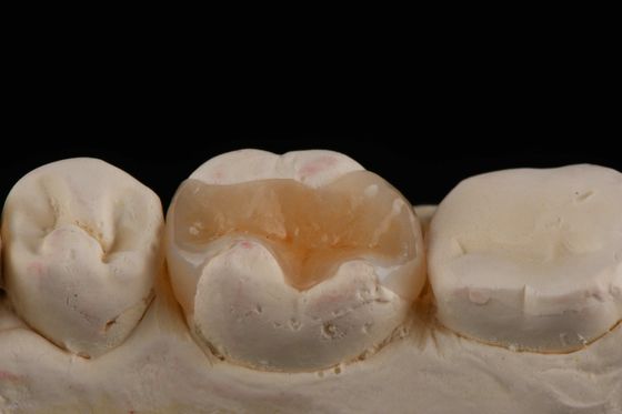 E Max Material Inlay e Onlay na Odontologia Restauração Estética Durável