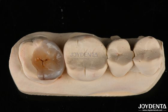 Inlays e Onlays Dentários Emax Personalizados para Restauração Dental