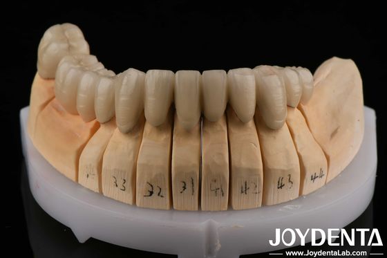 Porcelana PFM de liga de ouro fundida a metal Dental Compatível com camadas de porcelana