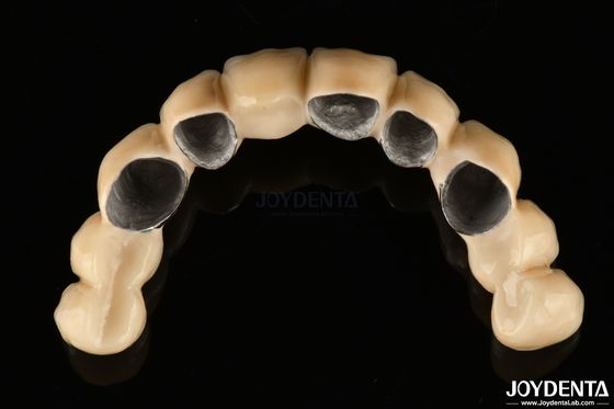 PFM cerâmica fundida com coroa de metal altamente biocompativel e resistente à corrosão