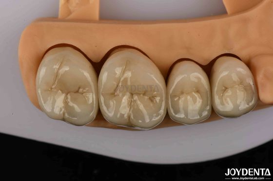 Coroas dentárias de ouro e de liga de paládio premium para maior durabilidade