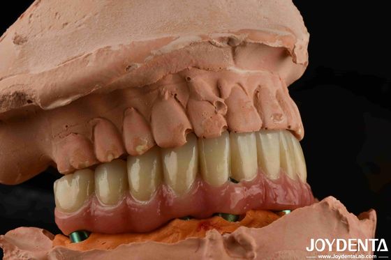 Titânio de baixa densidade Malong Hybrid Bridge Dental Peso leve Uso confortável