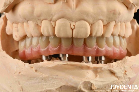 Ponte de implantes dentários híbridos de titânio Malong para aperfeiçoamento dentário