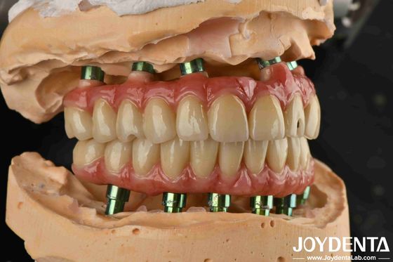 Tecnologia híbrida Titânio Malong ponte dental ajustável para resultados estéticos