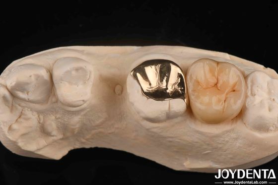 Coroa dental de ouro resistente ao desgaste com 60K Metal