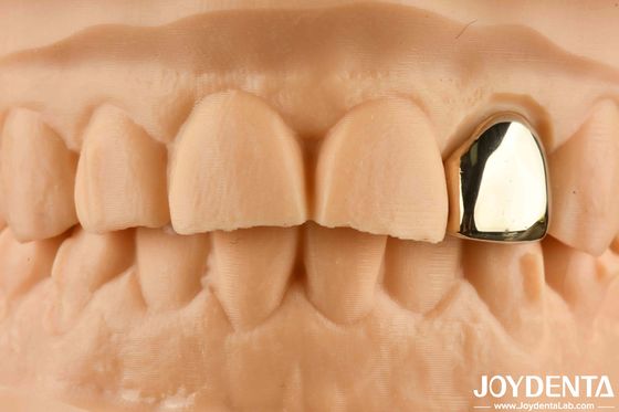 Ouro 60K coroa oral metálica resistente à abrasão coroa dental cera de fundição