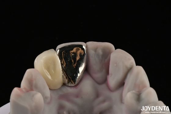 Metálico Dental Maryland Bridge boa função de mastigação para remediação duradoura
