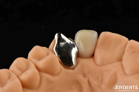 Material metálico personalizável PFM Maryland Cuidados dentários Reparação clínica oral