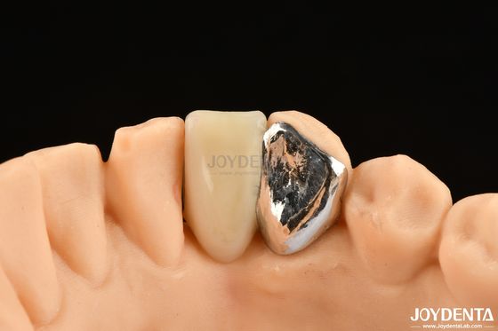 Ideal Combinação Clinical Bonding Maryland Dental Para trabalho de reparação clínica oral