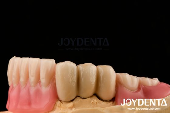 Prótese de aço inoxidável Prótese dentária parcial Prótese de bola de superfície polida