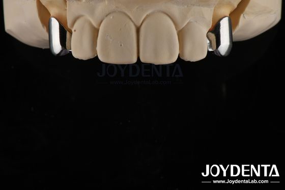 Prótese removível de precisão Aplicativos de implantes dentários Facil limpo Confortável