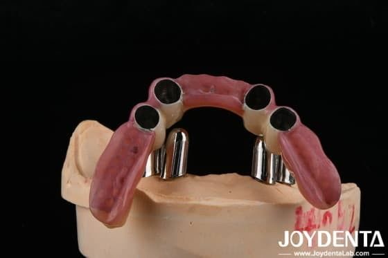 Aplicações dentárias de precisão apoiam dentaduras parciais Restaurações precisas