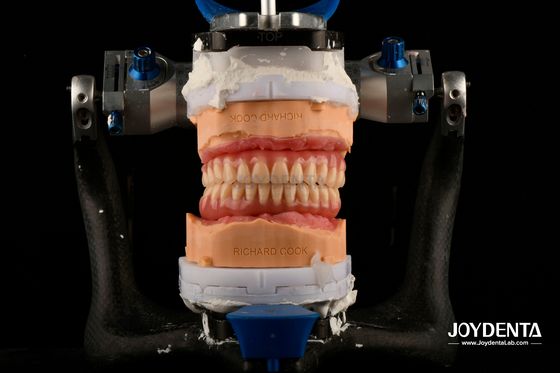 Dentadura Dentária Acrílica Leve Confortável Finalização de Personalização Profissional