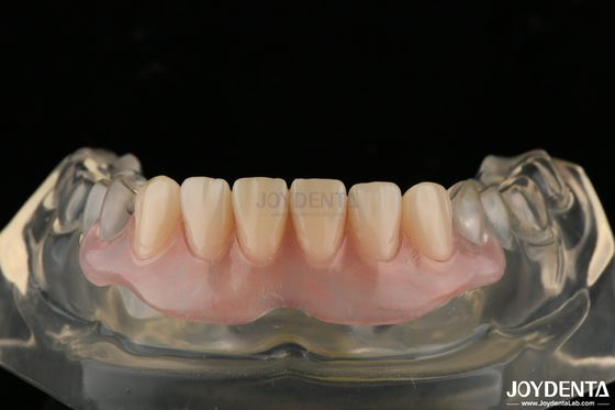 Dentadura invisível personalizada finalizada com tecnologia avançada de arranjo dentário