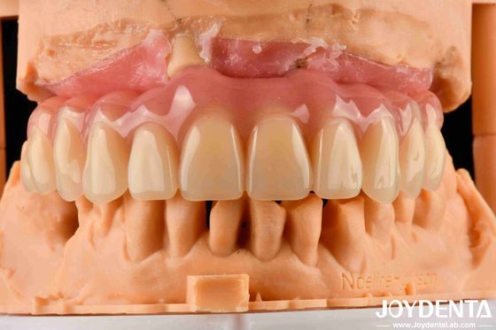 Prótese dentária acrílica com tecnologia de arranjo dentário