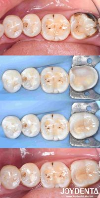 Restauração de inserção de porcelana dental personalizável para reparação de dentes perfeitamente ajustados