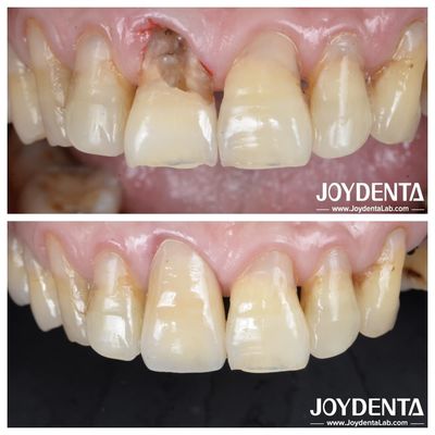 Dente de superfície lisa coroa de zircônio para restaurações posteriores e anteriores