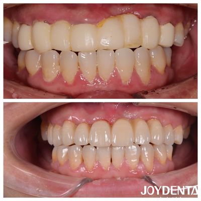 Ponte de zircônia dental de camadas múltiplas de cor natural para uma experiência ideal do paciente