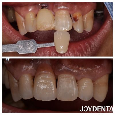 Fabricação Dentária de Circônio Fabricação Dentária de Circônio Fabricação Dentária Dentária de Circônio