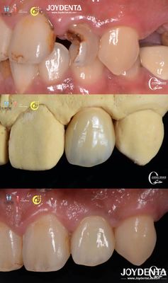 Aparição de dentes realistas Ponte de zircônio Restauração dental resistente ao desgaste personalizado