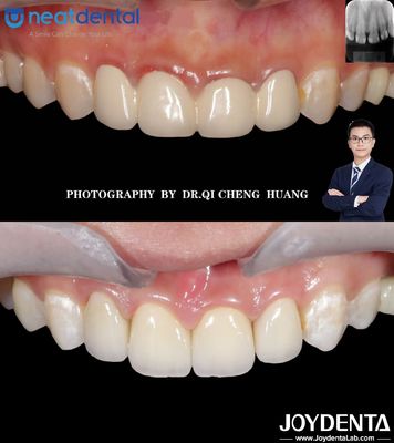 Coroa de zircônio de alta translucidez de múltiplas camadas para dentes anteriores e posteriores resistente a rachaduras