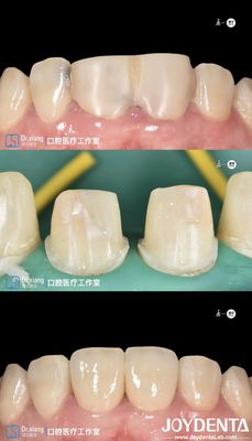 Dentes perfeitamente ajustados Coroas dentais de zircônio com sistemas CAD CAM para fabricação de precisão