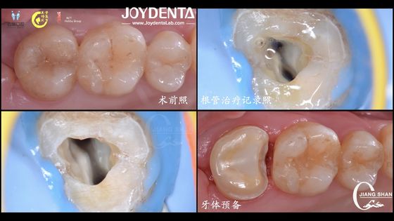 Incrustação de cerâmica dental de aparência natural e duradoura