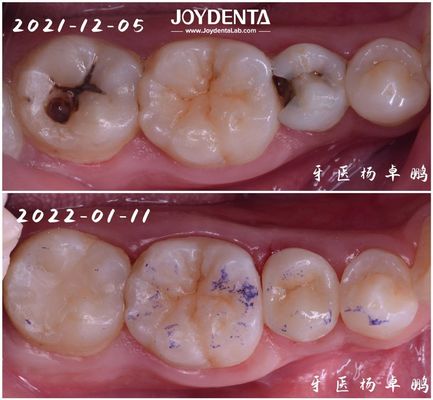 Alta Durabilidade Restauração dentária de inserção para dentes danificados Vários tamanhos disponíveis