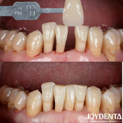 Forma Natural Cerâmica Maryland Bonded Bridge Restaurações Dentárias Excelente Estética