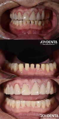 Forma natural Cosmética Odontologia Veneers de porcelana, Dental Cosméticos Veneers de porcelana