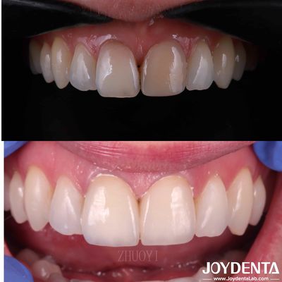 Finetes Dentários de Superfície Limpa para Dentes Torcidos, Finetes de Porcelana Cosmética Personalizados